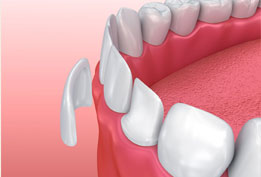 فیسینگ دندان