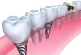 ایمپلنت های دندانی